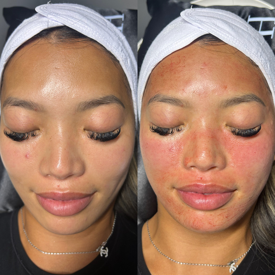 Microneedling results at SlimFit